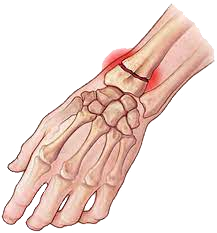 Fracture of wrist causing chronic pain